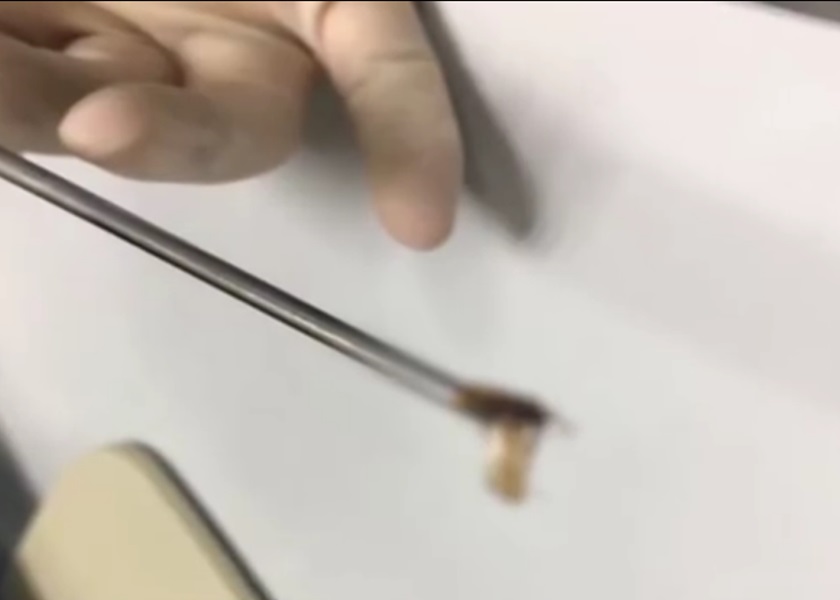 醫生需兩度滴麻醉藥,方成功將蟑螂取出。網圖