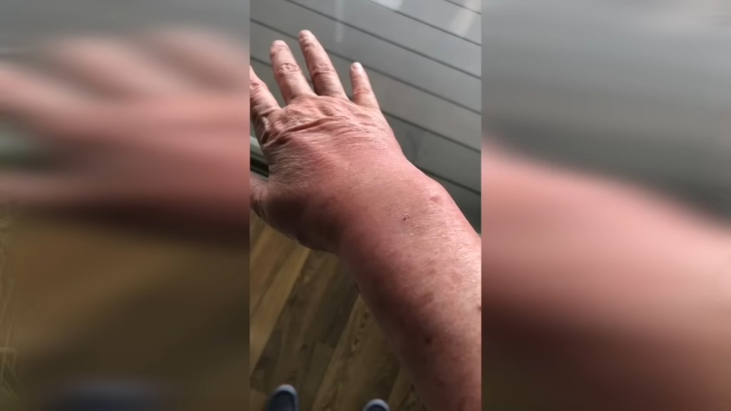 患病的蘇施黃右手曾腫到豬手咁。