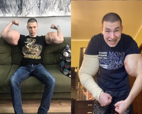 特雷辛將凡士林打進手臂變成巨肌，如今需面對多種後遺症。
kirill_tereshin_ruki_bazuki instagram圖片