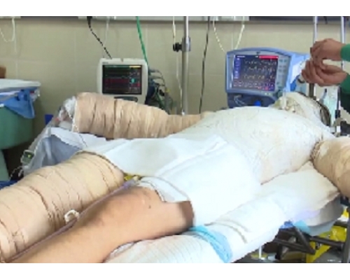 全身皮肤面积55%被烧伤的李连民。 网上图片