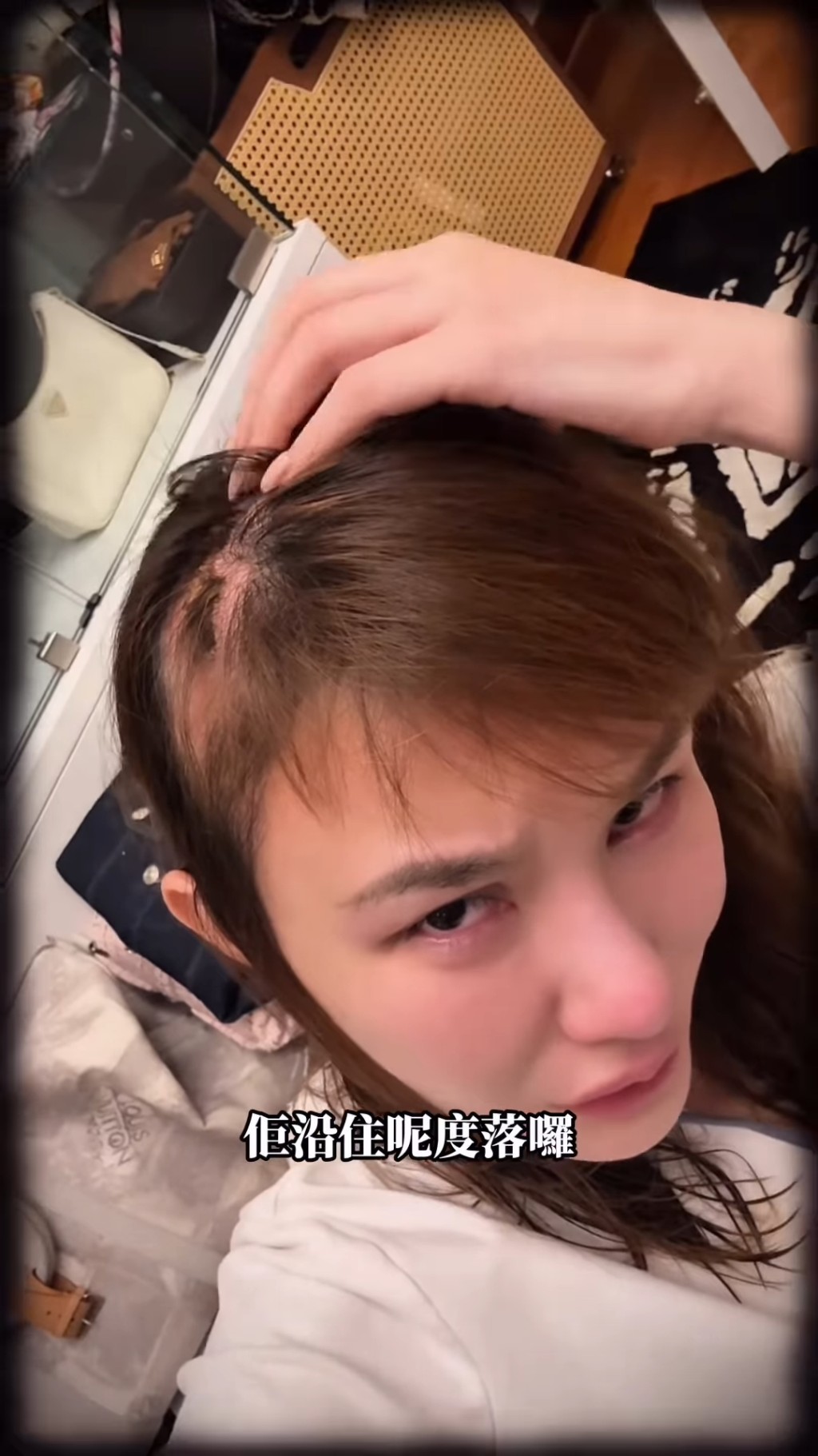 五索頭頂都有掉髮情況。 五索頭頂都有掉髮情況。