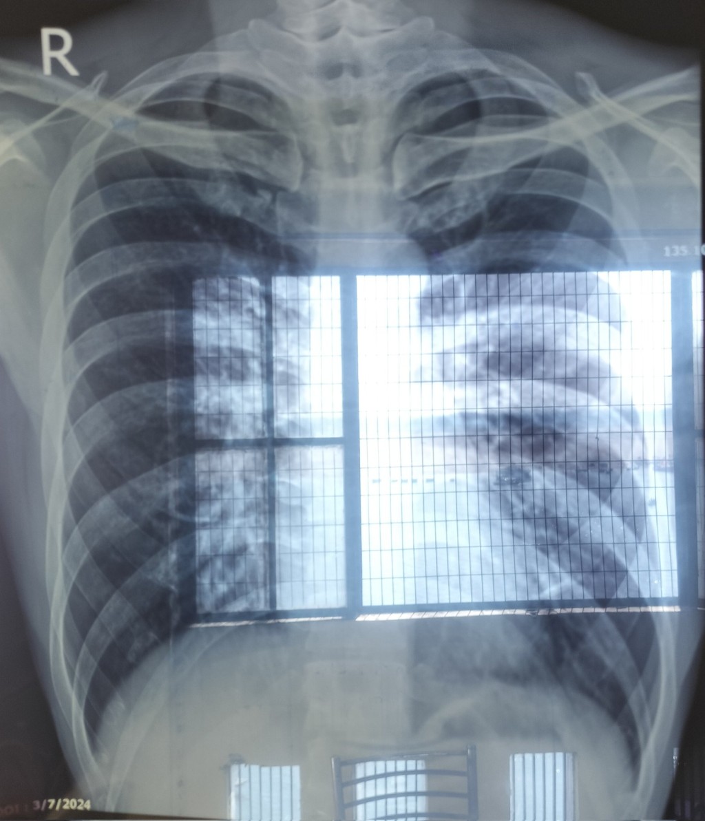 「Dotabata」事發發高燒、呼吸困難住院。 X@DorabataGG 「Dotabata」事發發高燒、呼吸困難住院。 X@DorabataGG