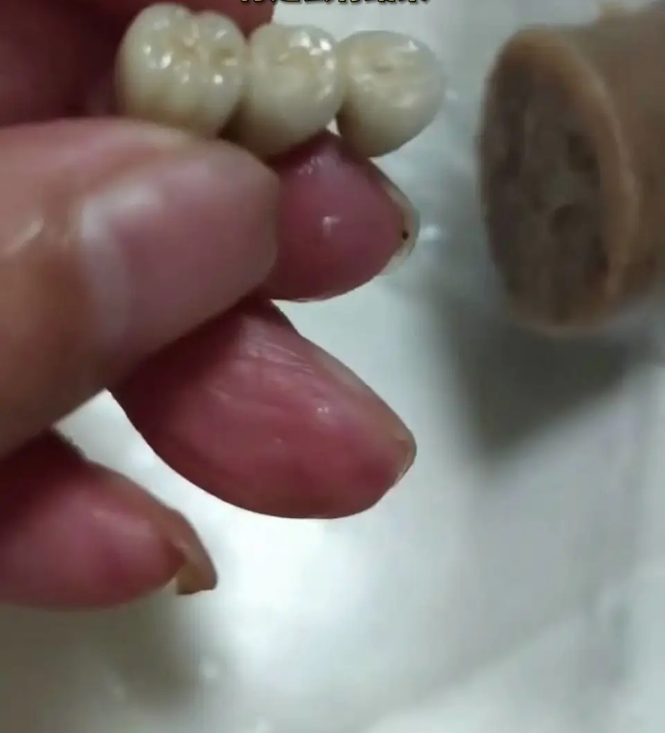 吉林食客香腸吃出三顆相連牙齒。 吉林食客香腸吃出三顆相連牙齒。