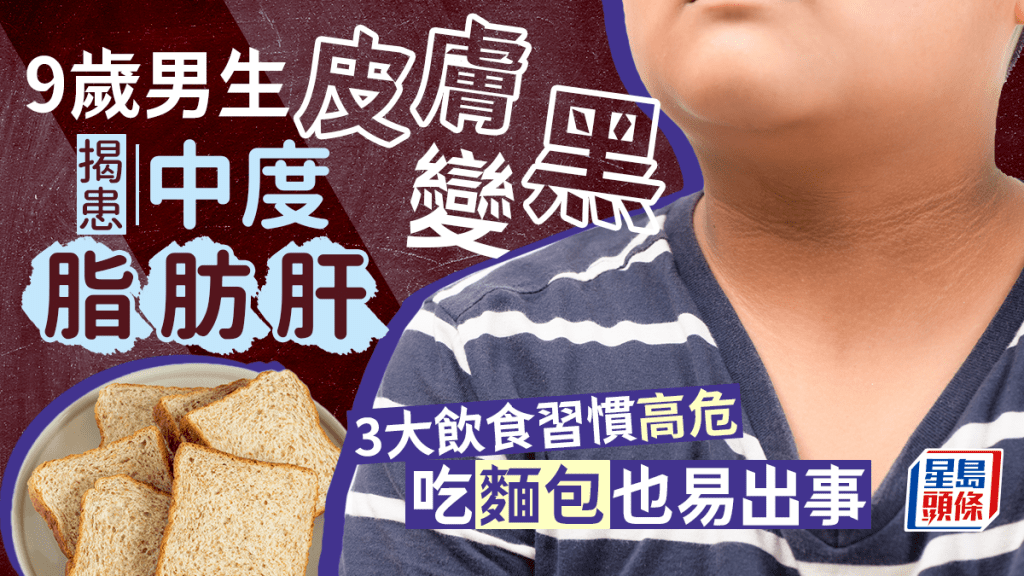 脂肪肝飲食｜9歲男生皮膚變黑揭患脂肪肝 麵包吃太多？3大飲食風險高