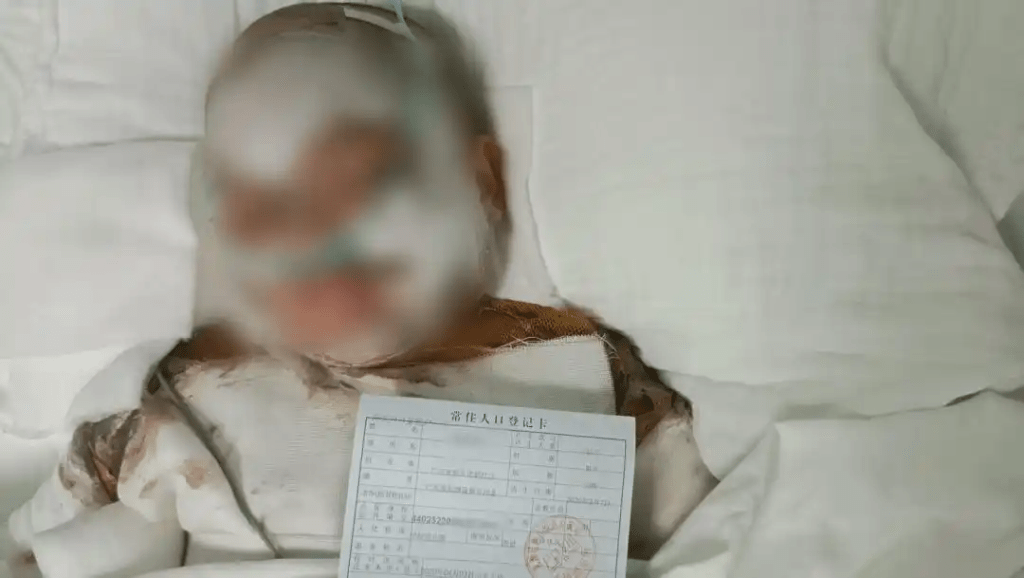 廣東5歲童掉進滾燙豆漿桶,全身80%燙傷命危。 廣東5歲童掉進滾燙豆漿桶,全身80%燙傷命危。