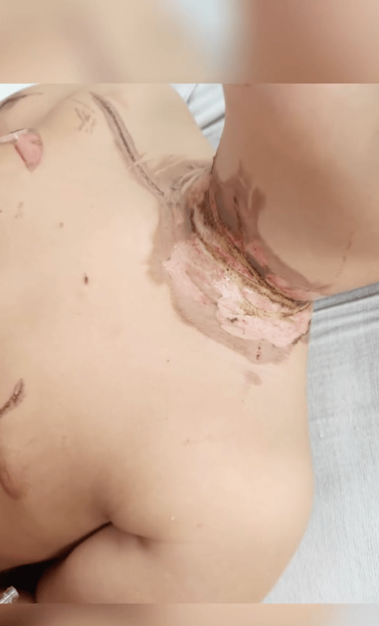 Lorenzo Lopez身上被電流灼傷的疤痕令人悚目驚心。