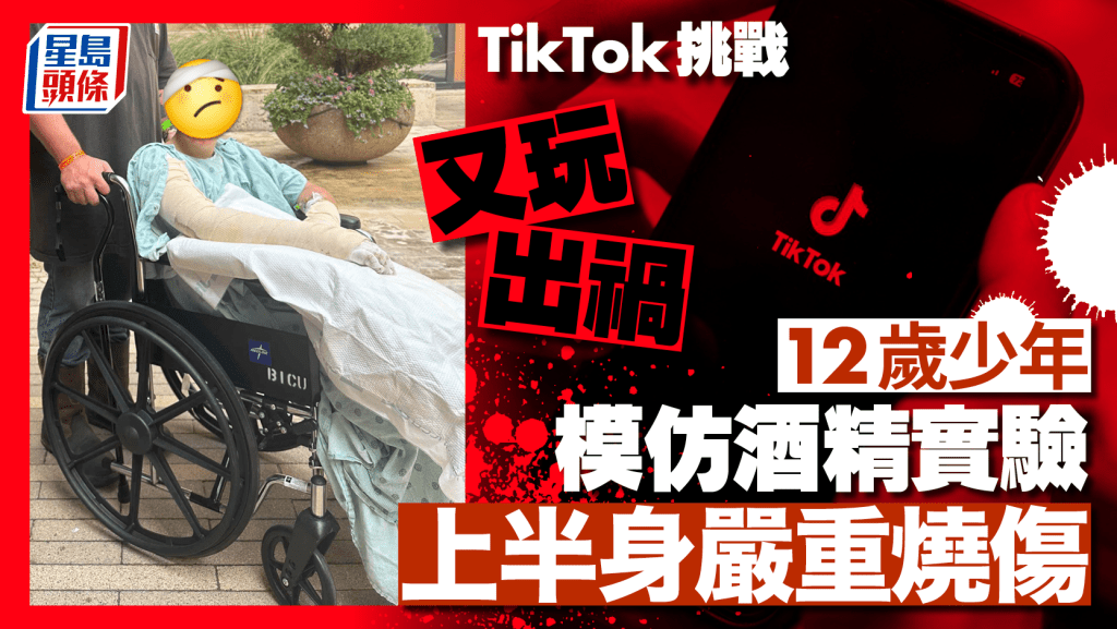 美12歲少年玩TikTok挑戰 模仿酒精實驗 衣服著火嚴重燒傷
