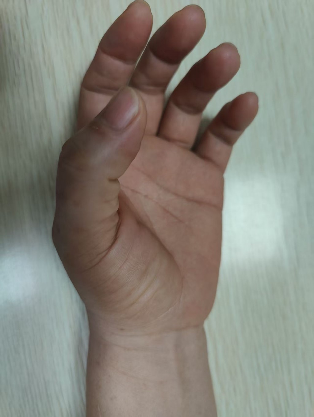 透過中醫浮針療法止痛消炎,助陳太改善媽媽手/腕管綜合症。(周惠珊醫師提供) 透過中醫浮針療法止痛消炎,助陳太改善媽媽手/腕管綜合症。(周惠珊醫師提供)