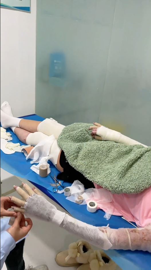 湖北女手機放枕邊通宵叉電，因充電器爆炸燒傷7成皮膚毀容。抖音＠依依的抗疤分享