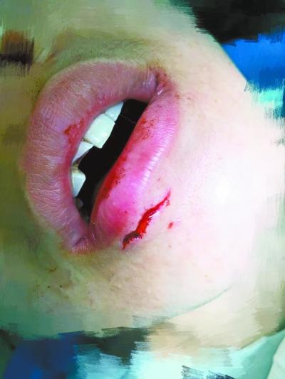 女子下唇需縫針。網上圖片