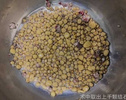 男子腎臟有1258顆結石。網圖
