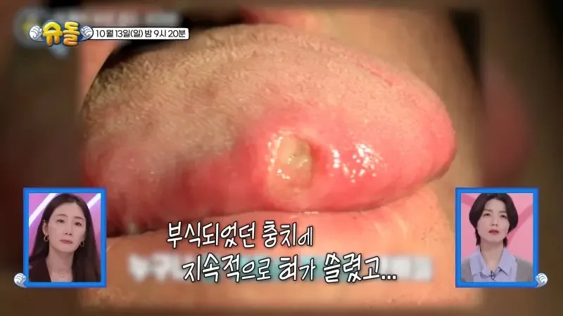 鄭美愛罹癌主因,與舌頭長期被腐爛的蛀牙摩擦受損有關。 鄭美愛罹癌主因,與舌頭長期被腐爛的蛀牙摩擦受損有關。