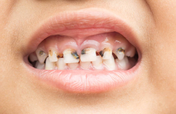 牙與牙之間、深的牙紋等，平時刷牙刷不到的地方會有大量牙菌膜，細菌長期在那裡製造酸性。（圖片來源：iStock）