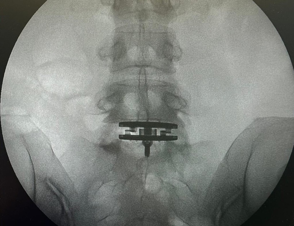 徐濠縈的腰椎X-ray。