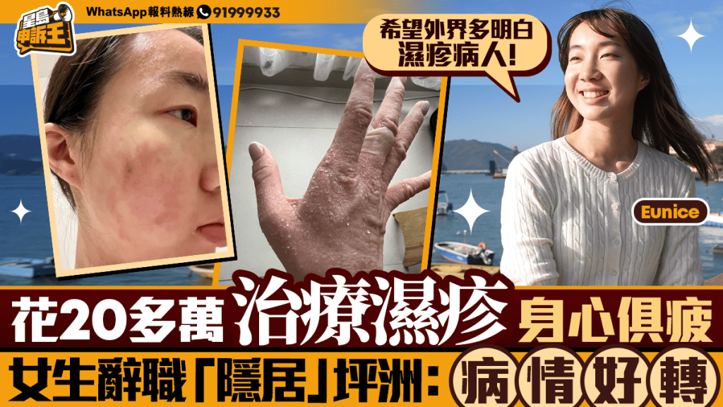 星島申訴王｜花費20萬醫濕疹一度「想放棄治療」  女生辭職搬入坪洲病情好轉：希望外界多理解