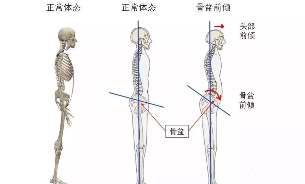 正常體態和骨盆前傾的對比。圖片由筆者提供 正常體態和骨盆前傾的對比。圖片由筆者提供