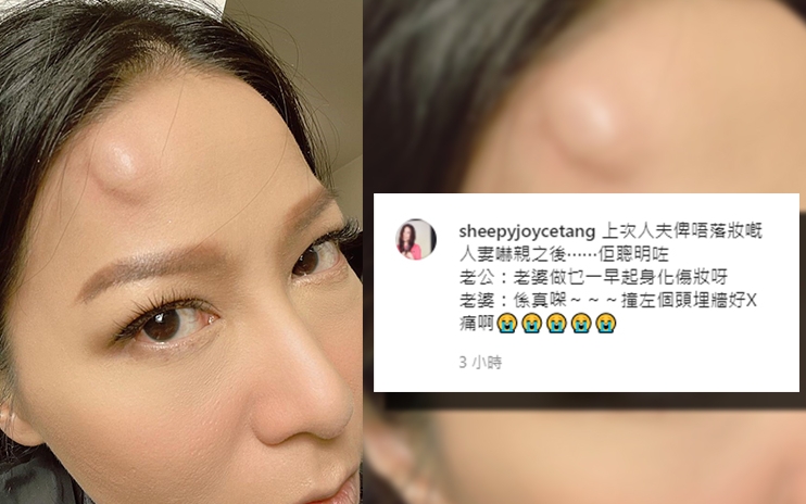 阿滕今日上載受傷照片，指老公上次被她的特技化妝欺騙後留有陰影，不再相信她。