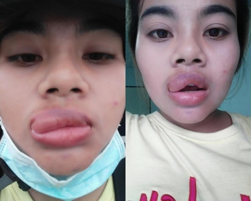 泰女食朋友咸酥虾手信后嘴唇爆肿。fb图片