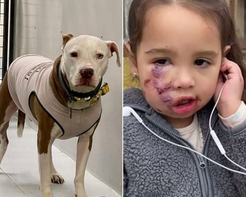 3歲女童被狗咬傷，狗主不顧而去，女童送院後縫15針日後需整形。（網圖）
