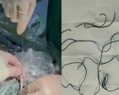 醫生用微創手術將一條長1.5米的電線取出。網圖
