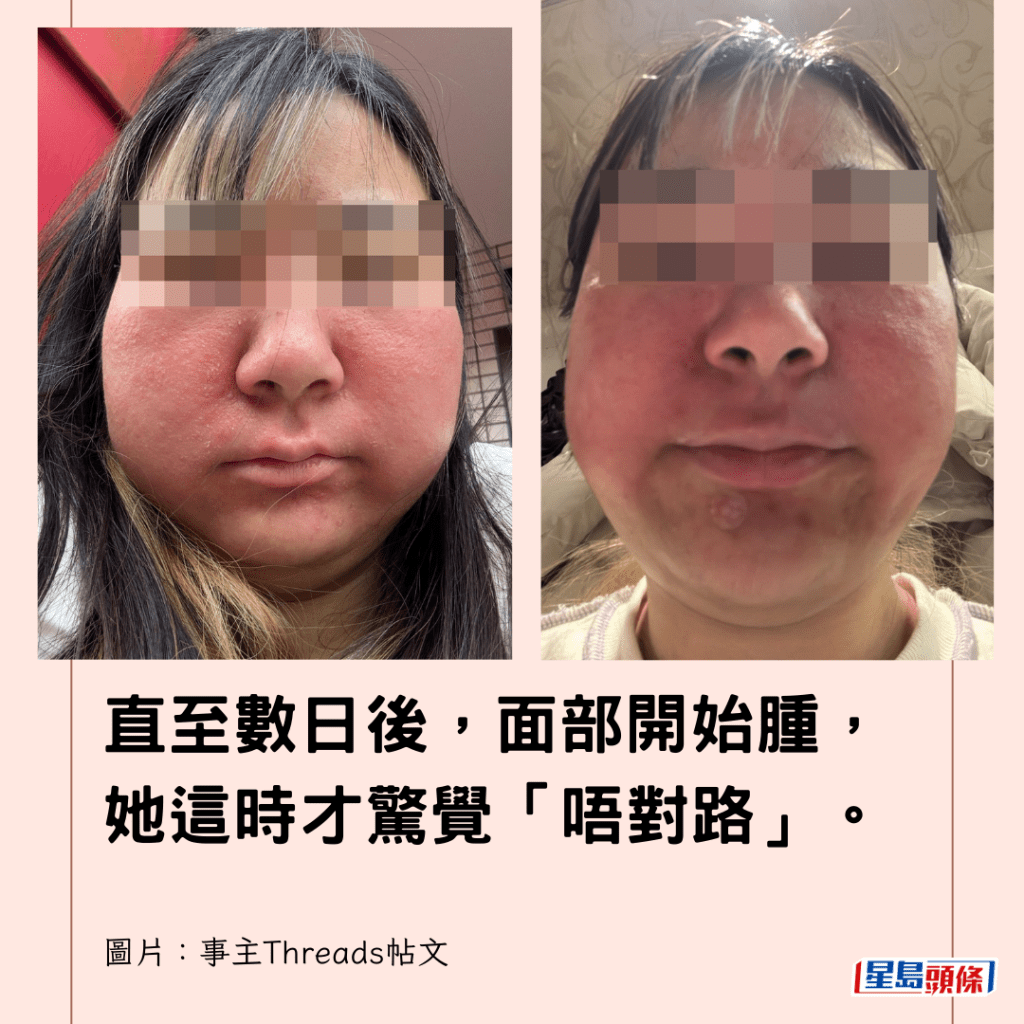 直至數日後，面部開始腫，她這時才驚覺「唔對路」。