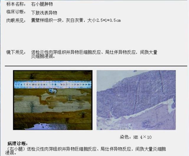 李小姐被竹籤插入肌肉內16年也不知，造成長期腳痺疼痛。三湘都市報
