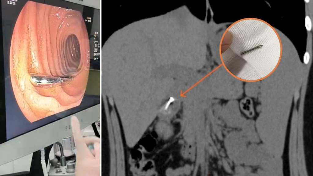 男孩誤吞圓規針，要由醫護團體透過術取出。《現代快報》