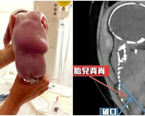 雖然嬰兒的背脊因而腫脹,但幾小時後已慢慢回復正常。網圖