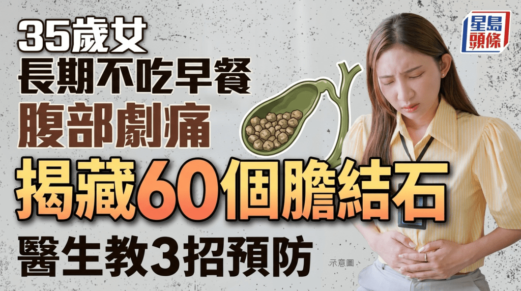 35歲女長期不吃早餐腹部劇痛 求醫揭藏60個膽結石 醫生教3招預防