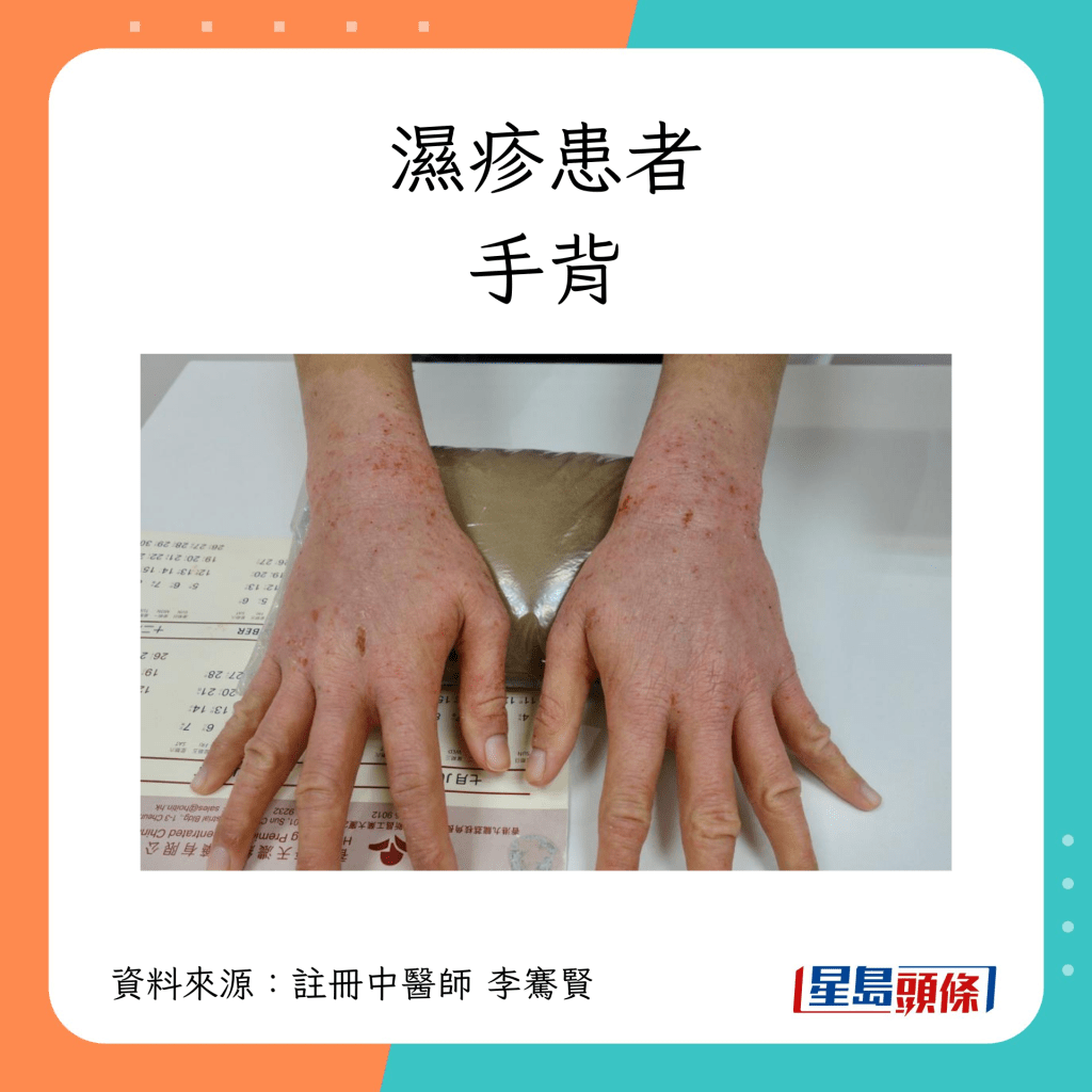 濕疹患者手背康復過程