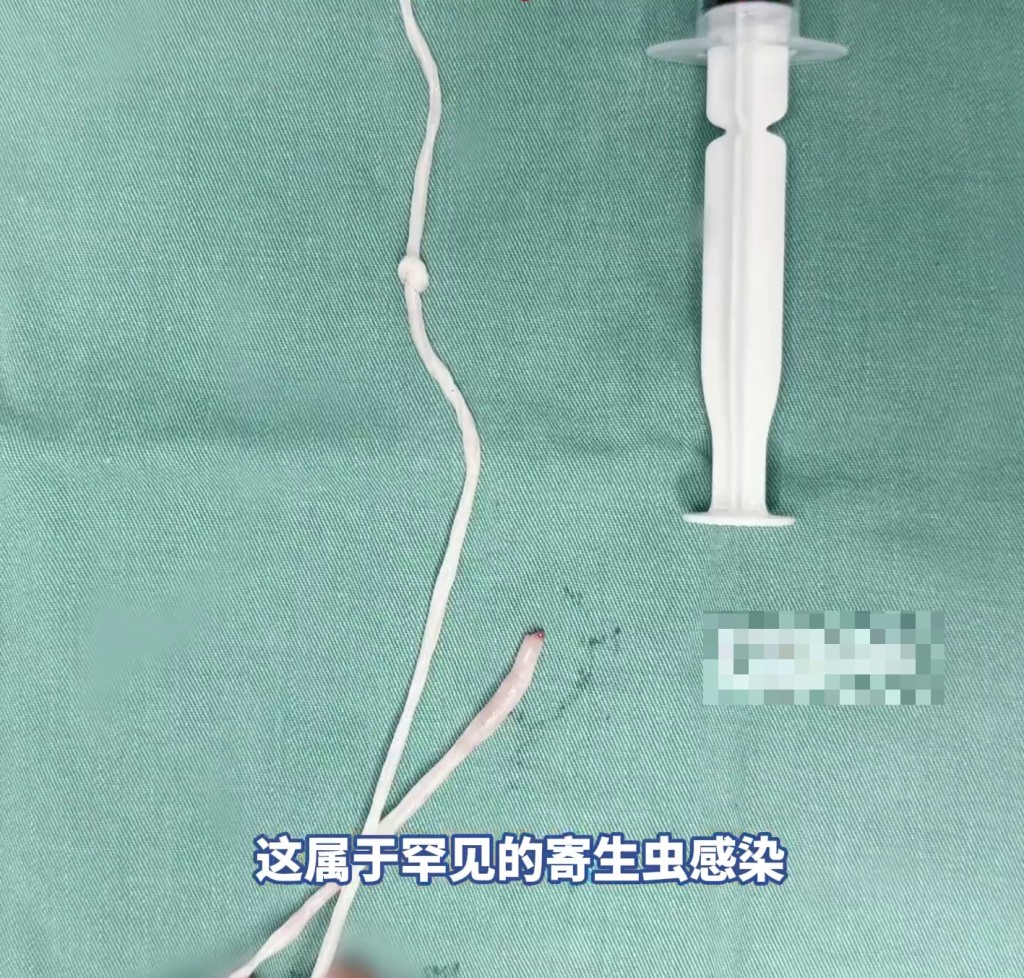 七旬妇乳房藏30cm活虫，医生成功取出。 极目新闻