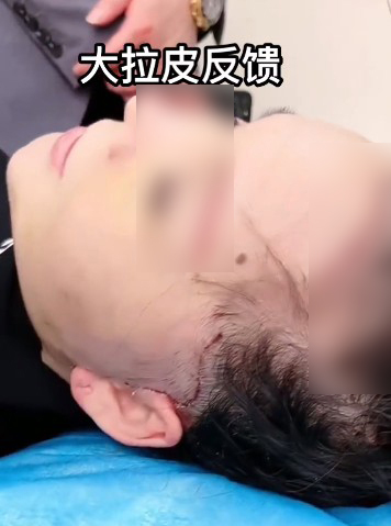 大面積拉皮，額頭有明顯傷口縫線。