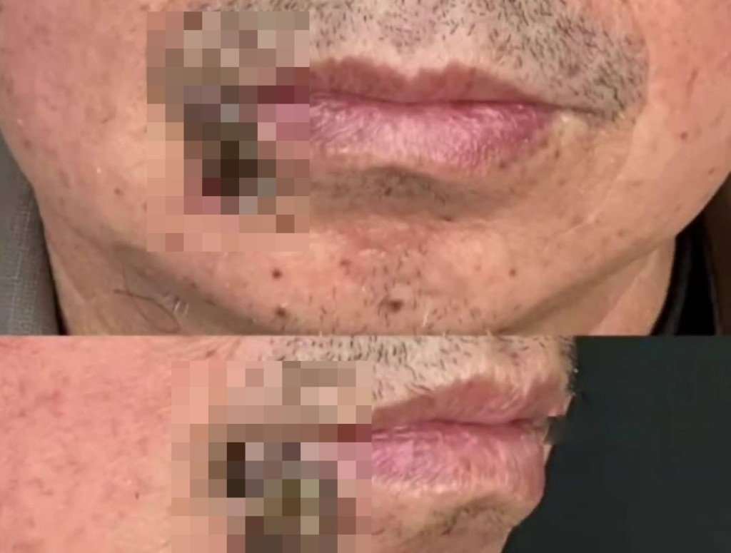 东莞一男子唇部长痘，8年拖成大肿瘤。