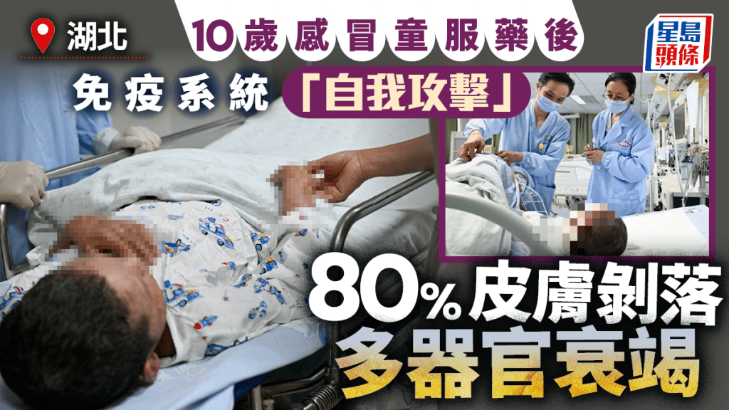 罕見過敏︱湖北10歲童感冒  服藥後80%皮膚「溶解」