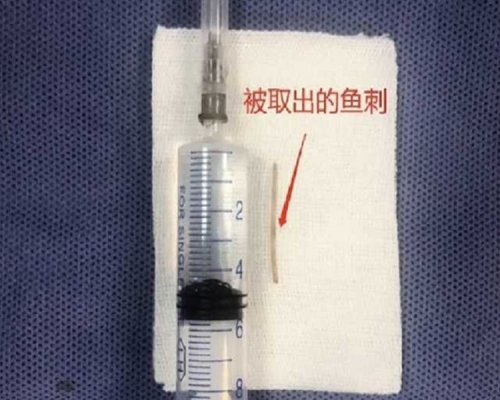 取出的魚骨。網圖