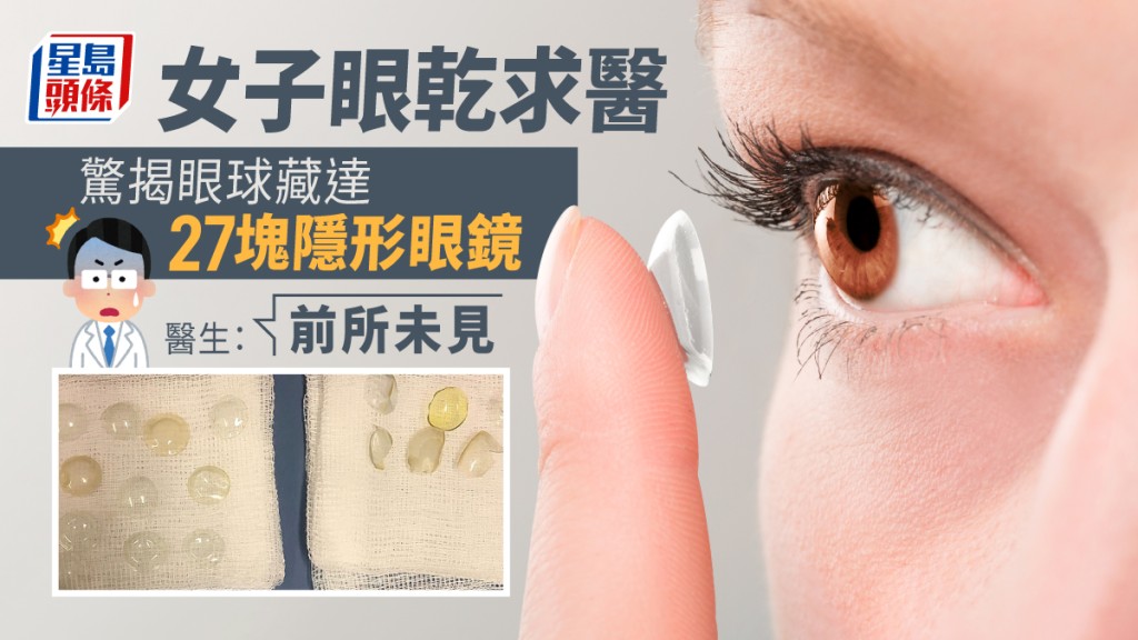一名女子因眼乾求醫，驚揭眼內藏27片隱形眼鏡。