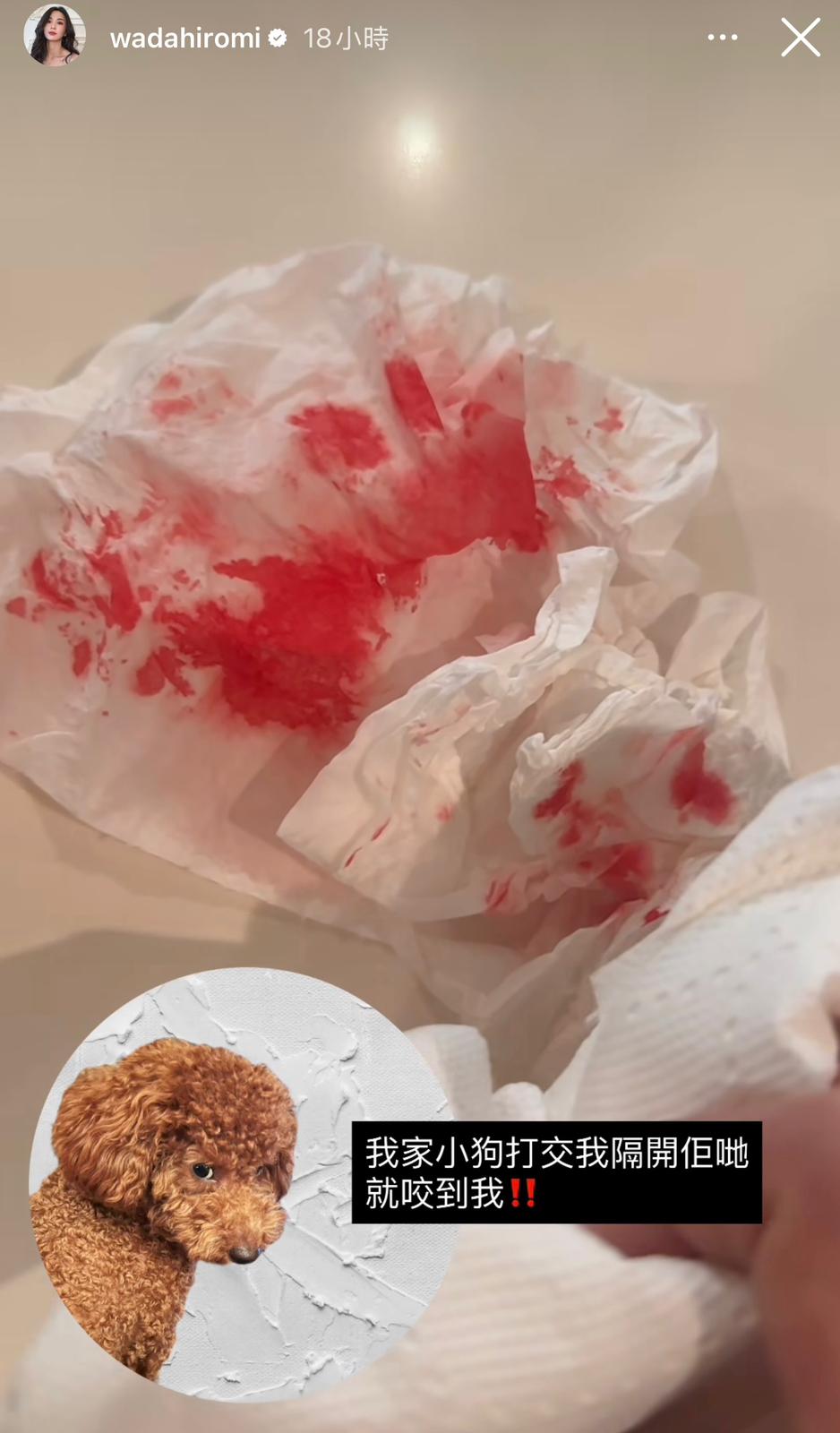 剛剛食物中毒完的裕美，當晚又在社交網表示，為分開兩隻愛犬打架，誤被咬到中指流血。