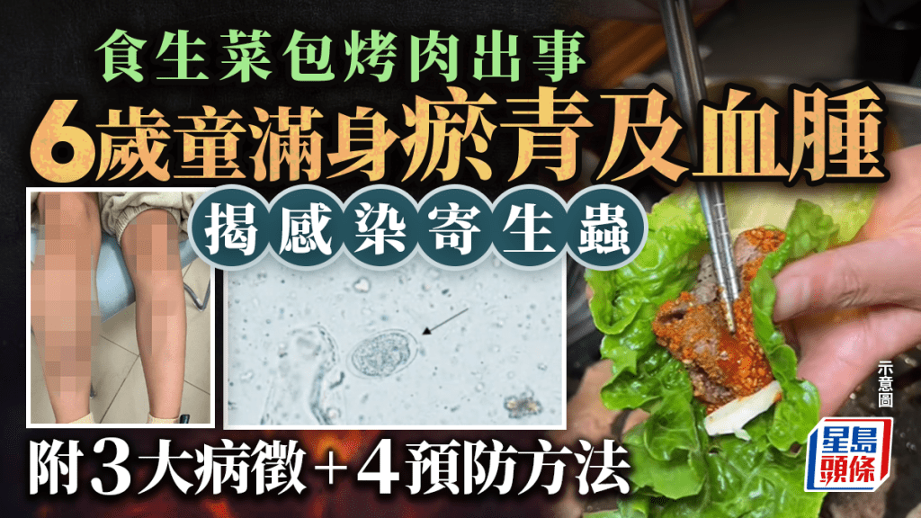 家長注意｜深圳6歲童食「生菜包烤肉」惹禍  滿身瘀青險當血癌