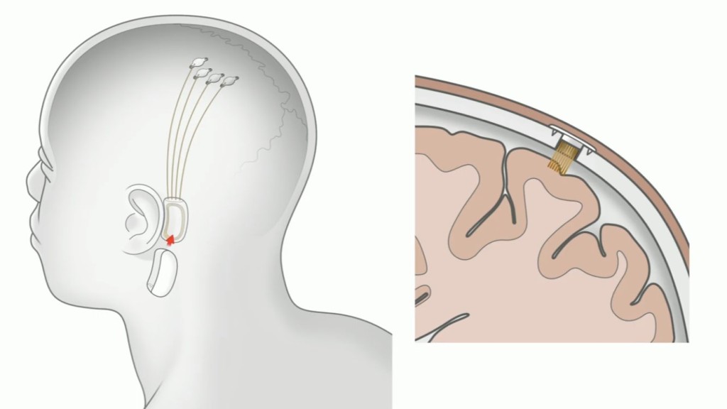 Neuralink正在開發脊髓植入物，可望能恢復癱瘓病人的行動能力，另外一種則是能夠植入眼部的東西，用於改善或恢復人類視力。TWITTER圖