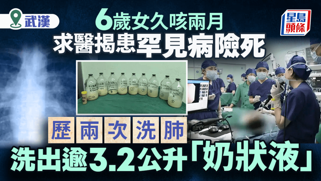 久咳兩個月｜6歲女童患罕見肺泡蛋白沉積症險死  雙肺洗出3.2公升奶狀物