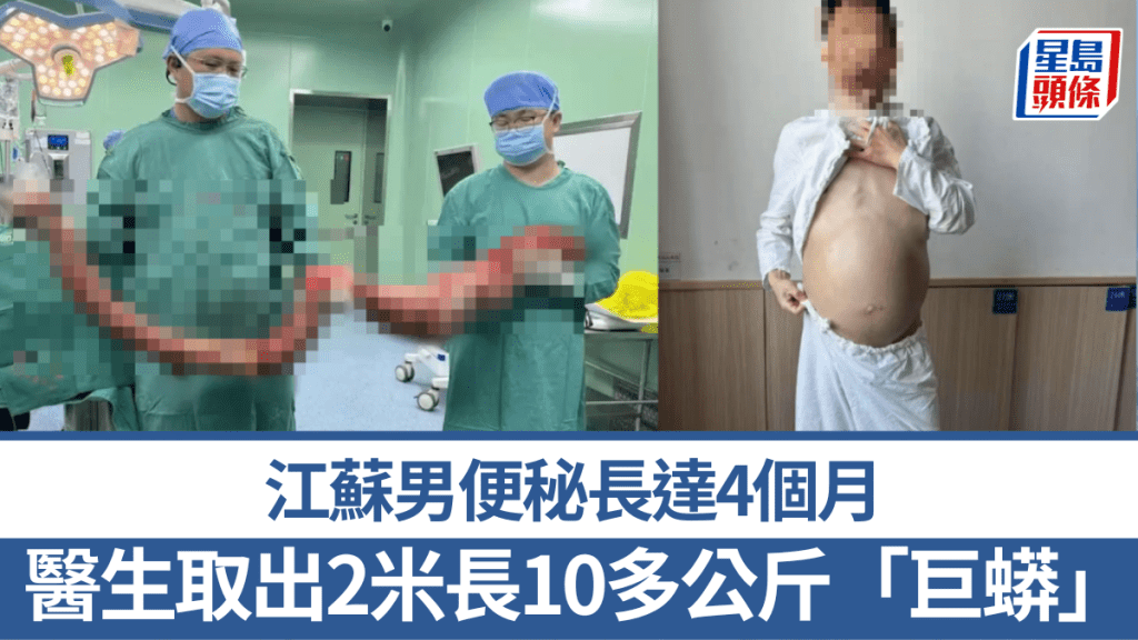 江蘇男便秘長達4個月,醫生取出2米長10多公斤「巨蟒」結腸。