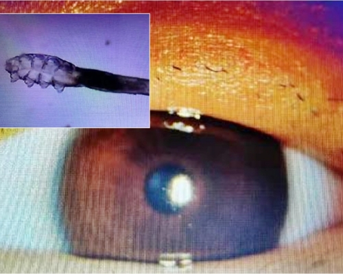 溫州一名女子植假睫毛後，發現根部長滿一條條蟎蟲。網圖