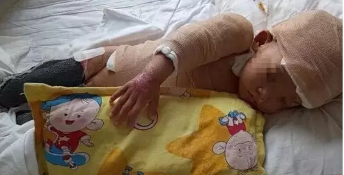 王福星全身四成皮膚遭燒傷。網上圖片