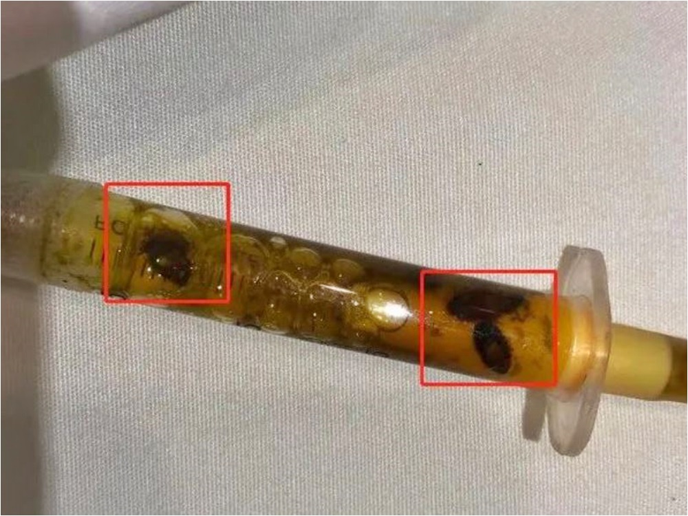 番禺一名男子因多年進食魚生,導致體內出現寄生蟲。網圖