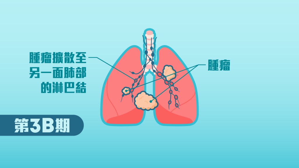 第3B期肺癌