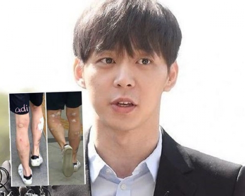 有媒體翻炒多張朴有天過往在小腿位置及手部滿佈傷痕的舊照。網圖