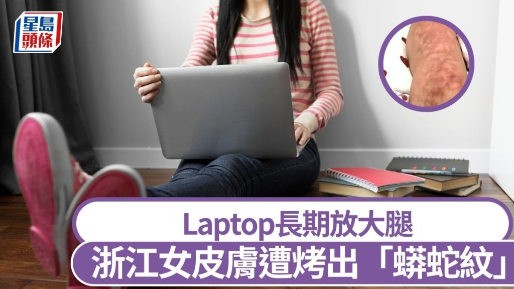 浙江有女子長期把手提電腦放在腿上工作,出現「蟒蛇紋」。freepik