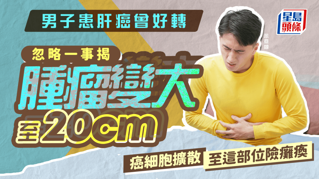 男子患肝癌曾好轉 忽略一事揭腫瘤變大至20cm 癌細胞擴散至這部位險癱瘓