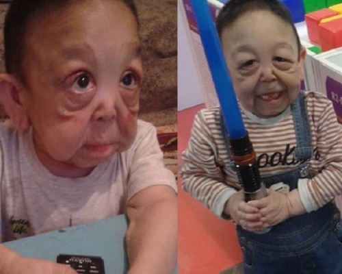男童患罕见病，身体状态如80岁老人。网图