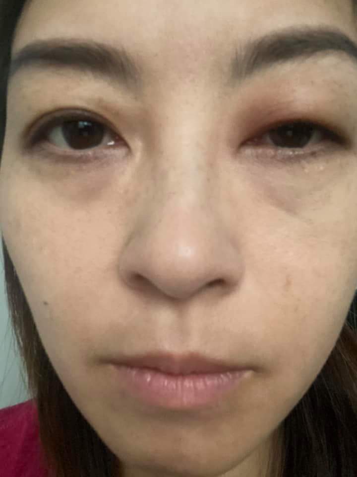以為被蚊咬。